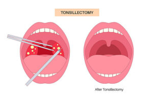 Tonsil Removal Surgery in Kandivali